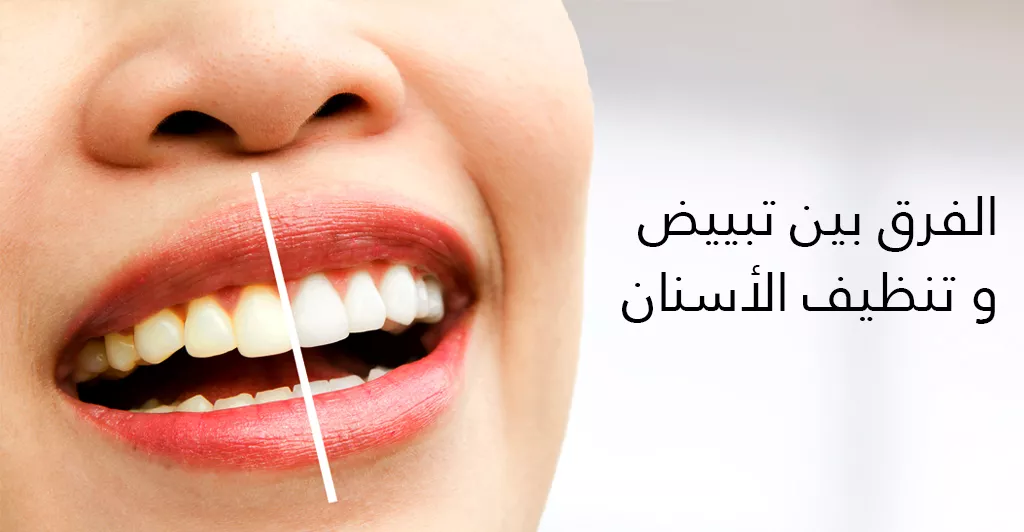 فوائد تبييض الأسنان و أسباب اللجوء إليها 